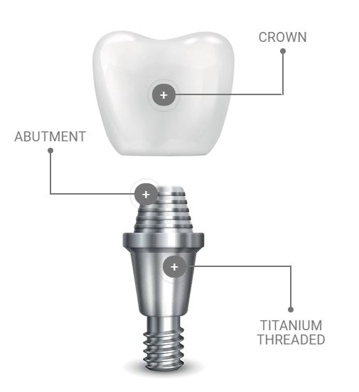 Implant Marketing Image